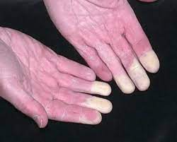 Close-up of hands with  loss of circulation 

